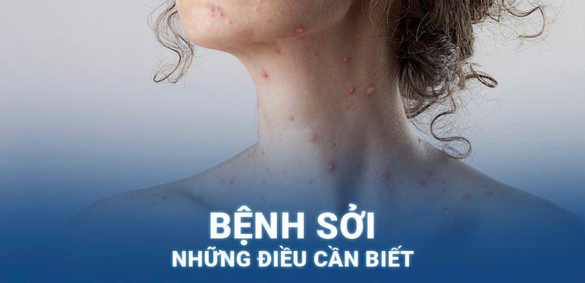 Phòng, chống bệnh Sởi