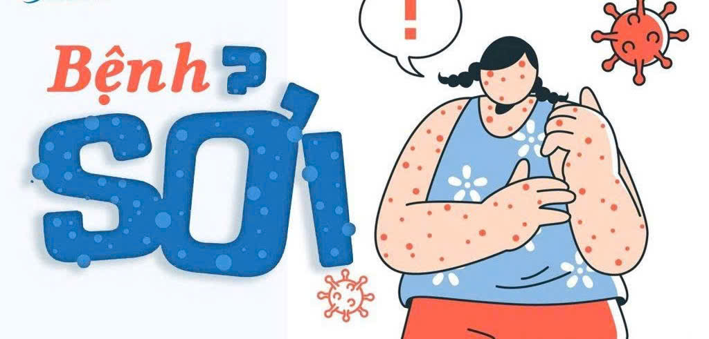 Những điều cần biết về bệnh sởi